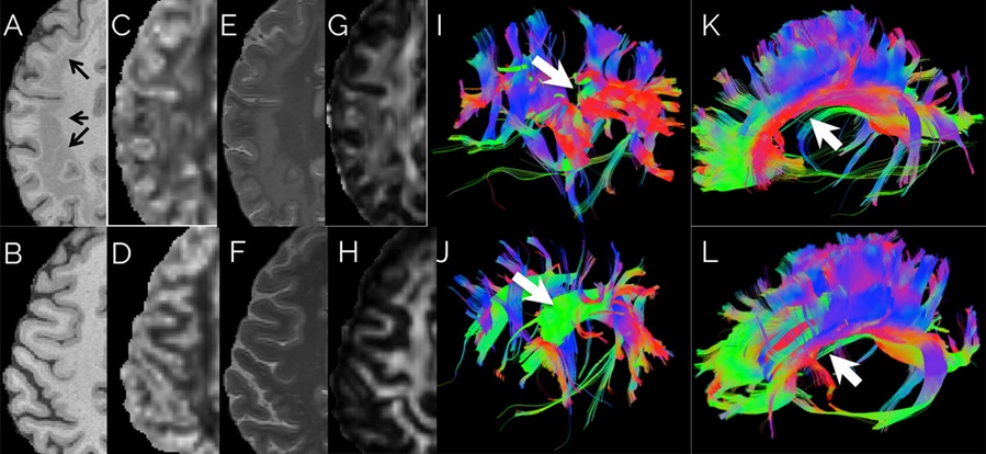 •	Advanced imaging shows abnormalities in white matter tracts of patient with a rare genetic form of epilepsy 